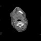 Carcinoma of the mouth floor and tongue: CT - Computed tomography